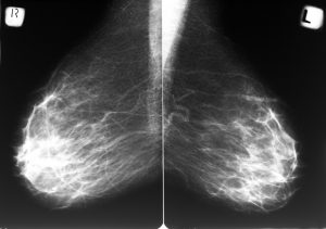 mammograms_radiation_breastcancer